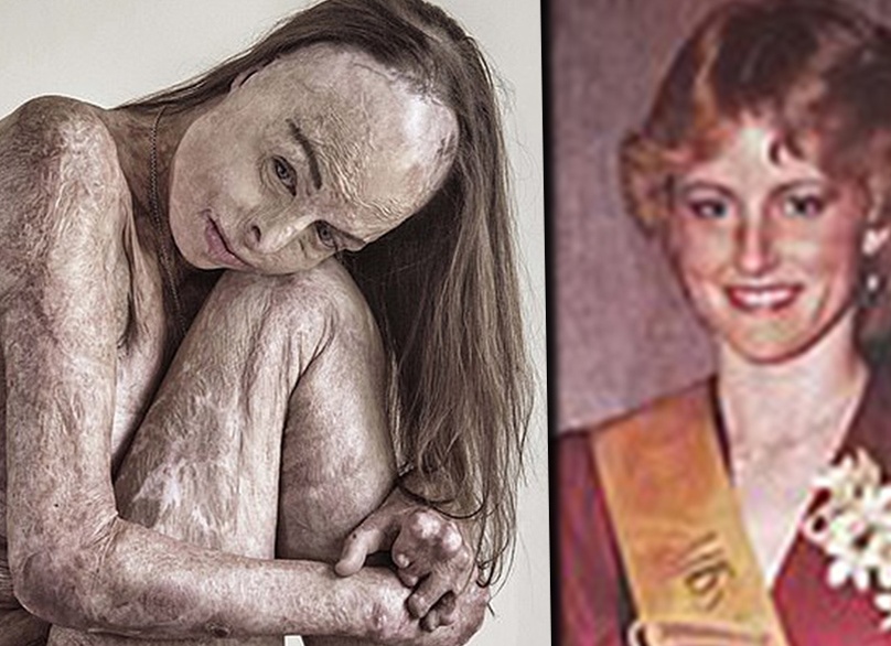 Как выглядит экс-королева красоты которая при пожаре получила ожоги 85 лица и тела