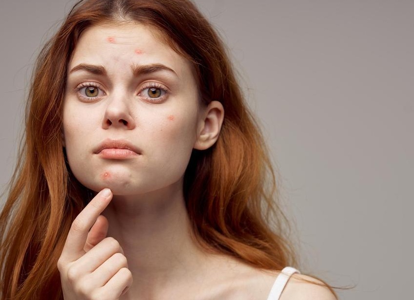 Как быстро избавиться от прыща 5 способов